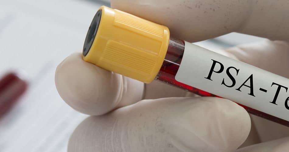 Test PSA - Antigene prostatico specifico
